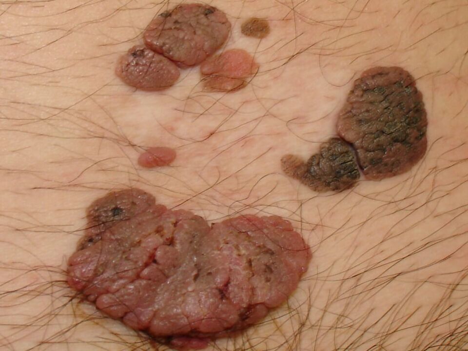 papillomas on the skin