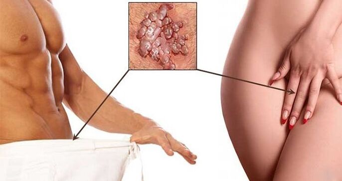 Condylomas in the genital area of ​​men and women. 