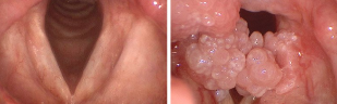 Human papillomavirus in the mouth