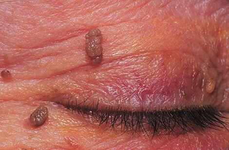 Papillomas on the skin of the eyelids that require treatment. 