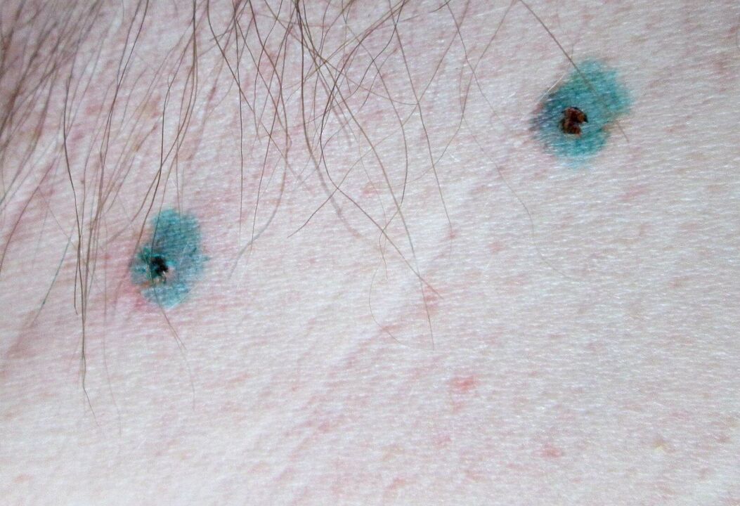 Marks on the skin after laser papilloma removal. 