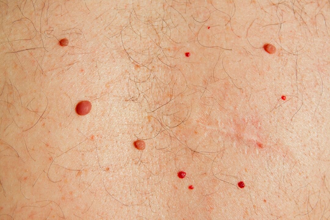 Papillomas on the body caused by HPV. 